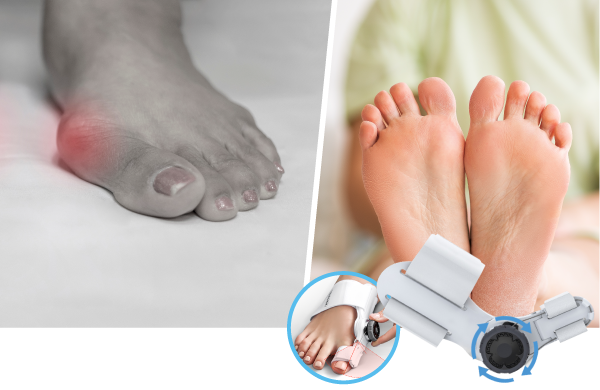 At long last, a bunion corrector that really works! Helps relieve pain and straightens the big toe